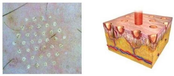 Il laser frazionario influenza il punto della pelle