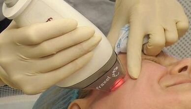 Come viene eseguito il ringiovanimento cutaneo frazionato