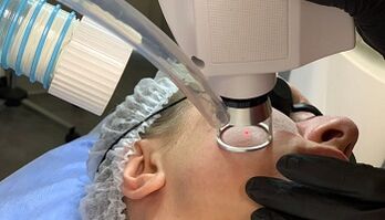 Ringiovanimento laser della pelle del viso
