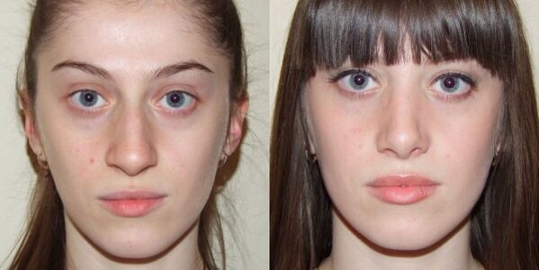 Ragazza prima e dopo il ringiovanimento della pelle del viso al plasma